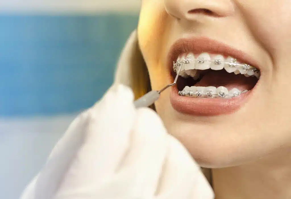 Braces 101