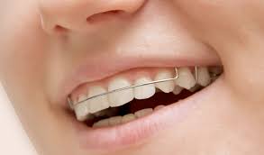 Why Retainers Are Essential