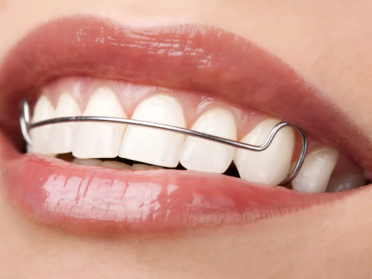 Retainers